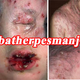Illustration for article titled cara menyembuhkan herpes